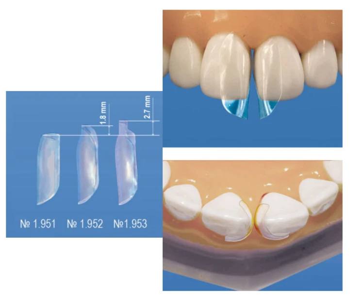 matryce transparentne do przednich zębów