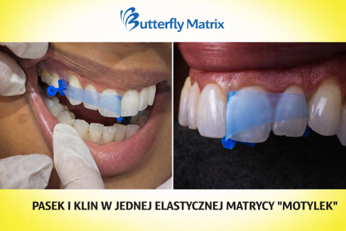 Butterfly Matrix – pasek i klin w jednej elastycznej matrycy