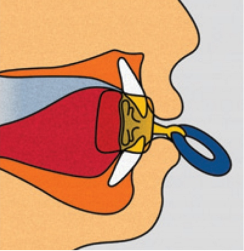 Płytka przedsionkowa Schoenherra średnia nr 2 (2).png