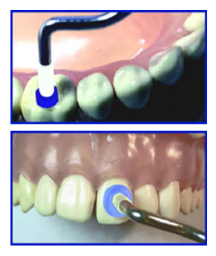 Zestaw do odbudowy guzków i powierzchni przednich zębów