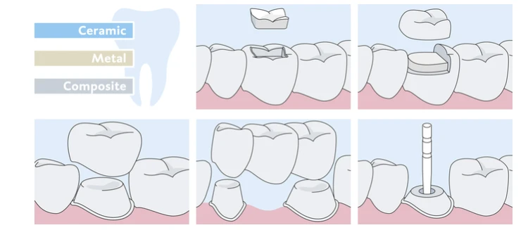 PermaCem 2.0. DMG — wysokiej jakości materiały dentystyczne dla stomatologów i techników dentystycznych.png
