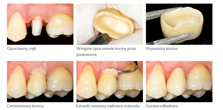 PermaCem 2.0. DMG — wysokiej jakości materiały dentystyczne dla stomatologów i techników dentystycznych (2).png